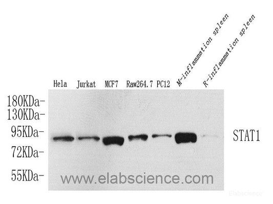 Immunohistochemistry analysis of paraffin-embedded human lung cancer   using HDAC1 Polyclonal Antibody at dilution of 1:300.