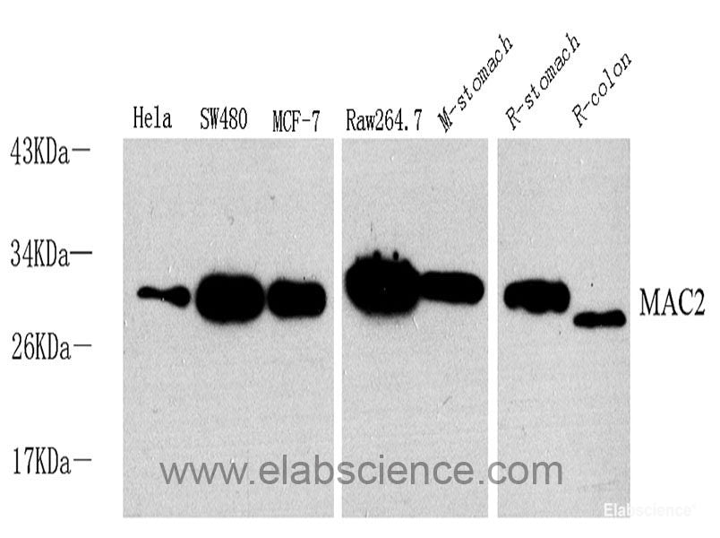 Immunohistochemistry analysis of paraffin-embedded human stomach cancer  using HSPA5 Polyclonal Antibody at dilution of 1:300.