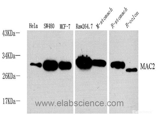 Immunohistochemistry analysis of paraffin-embedded human stomach cancer  using HSPA5 Polyclonal Antibody at dilution of 1:300.