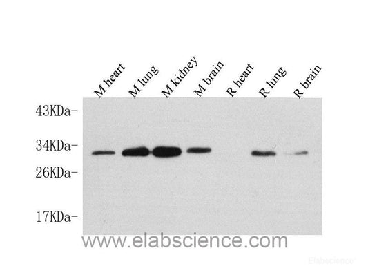 Immunohistochemistry analysis of paraffin-embedded human stomach cancer  using CDK4 Polyclonal Antibody at dilution of 1:100.