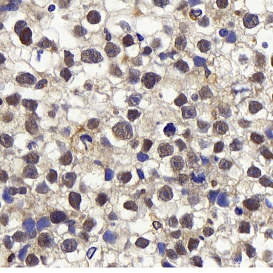 Immunohistochemistry analysis of paraffin-embedded human lung cancer  using HDAC2 Polyclonal Antibody at dilution of 1:1000.