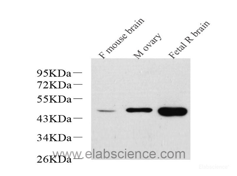 Immunohistochemistry analysis of paraffin-embedded human endometrial cancer  using PGR Polyclonal Antibody at dilution of 1:300.
