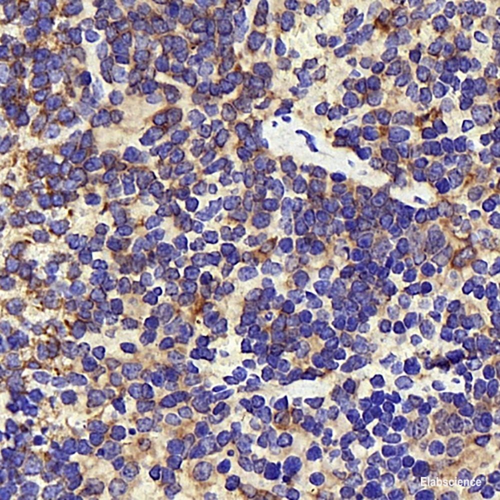Immunohistochemistry analysis of paraffin-embedded human lung cancer  using IkB alpha Polyclonal Antibody at dilution of 1:500.