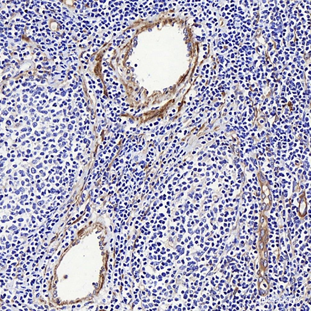 Immunohistochemistry analysis of paraffin-embedded human stomach cancer  using MMP9 Polyclonal Antibody at dilution of 1:200.