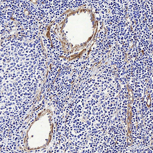 Immunohistochemistry analysis of paraffin-embedded human stomach cancer  using MMP9 Polyclonal Antibody at dilution of 1:200.