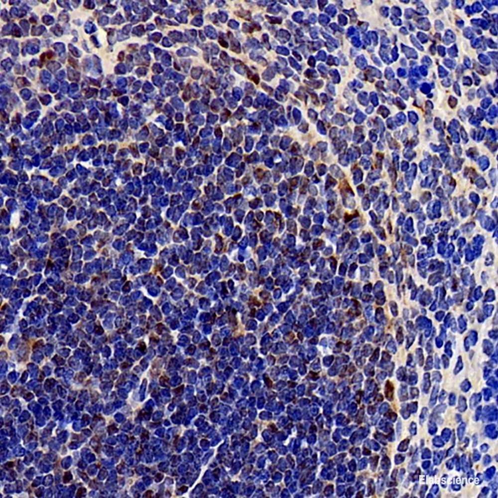 Immunohistochemistry analysis of paraffin-embedded human lung cancer   using ATF6 Polyclonal Antibody at dilution of 1:400.
