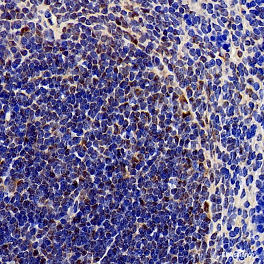 Immunohistochemistry analysis of paraffin-embedded human lung cancer   using ATF6 Polyclonal Antibody at dilution of 1:400.