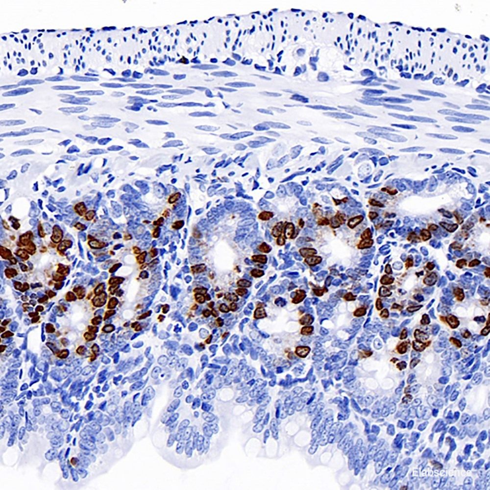 Immunohistochemistry analysis of paraffin-embedded human Lymphoma  using LDLR Polyclonal Antibody at dilution of 1:300.