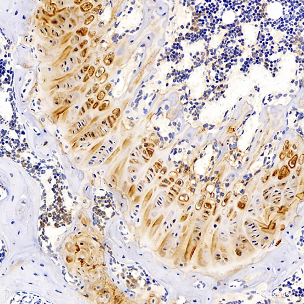 mmunohistochemistry analysis of paraffin-embedded human stomach cancer  using ENO2 Polyclonal Antibody at dilution of 1:300.