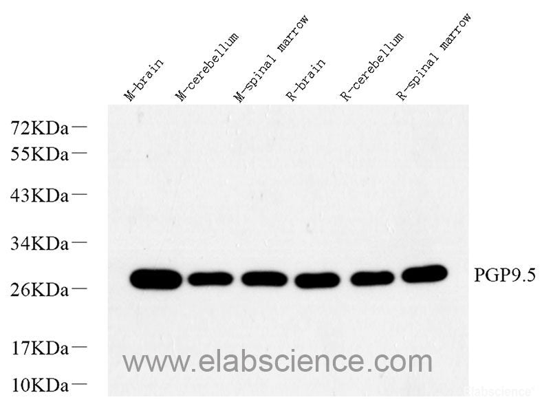 Immunohistochemistry analysis of paraffin-embedded human breast cancer  using ATG7 Polyclonal Antibody at dilution of 1:400.