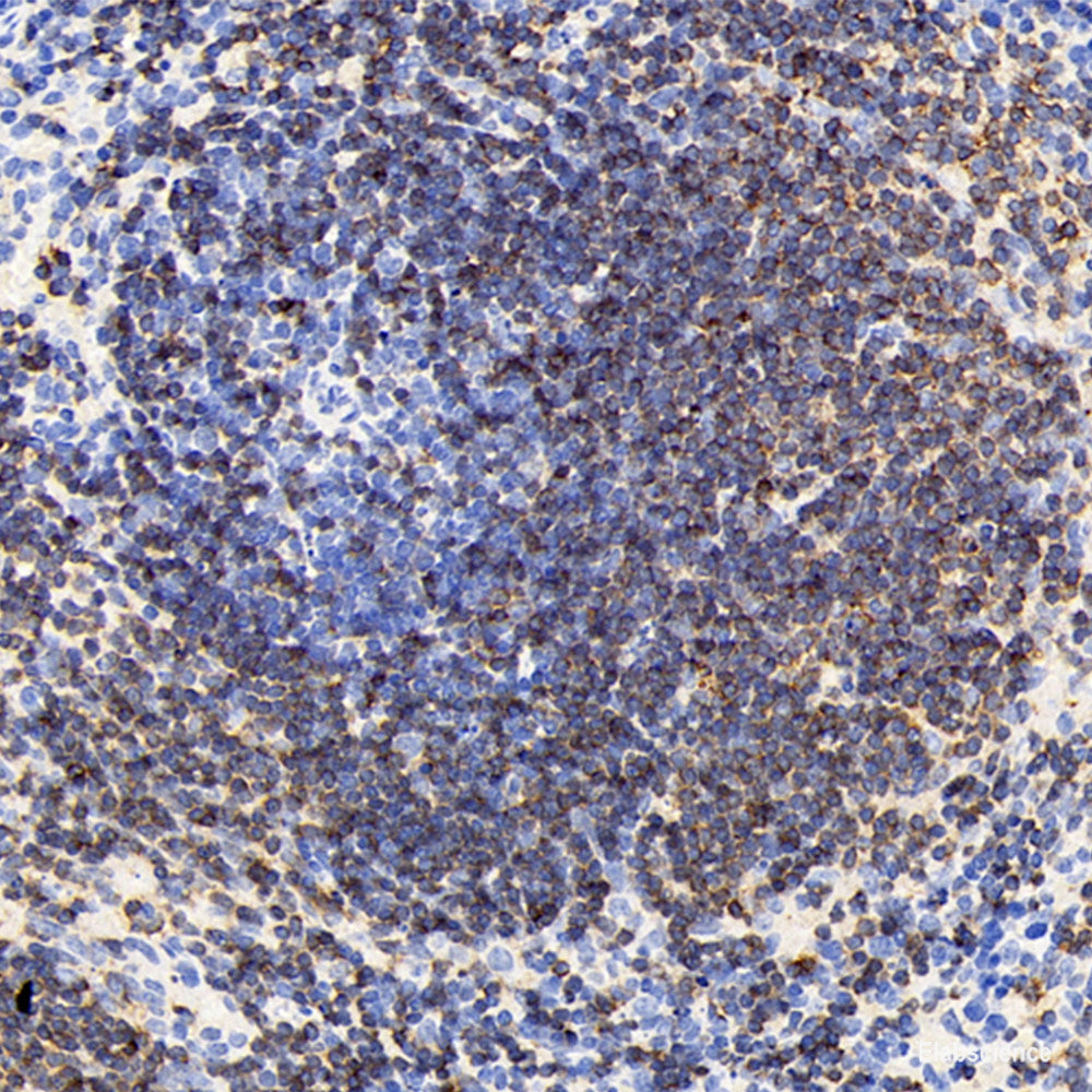 Immunohistochemistry analysis of paraffin-embedded human liver cancer  using ATG5 Polyclonal Antibody at dilution of 1:400.