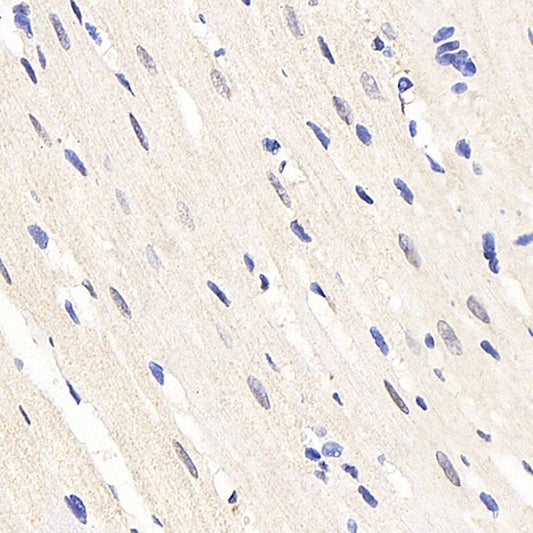 Immunohistochemistry analysis of paraffin-embedded human liver cancer  using IGF1 Polyclonal Antibody at dilution of 1:500.