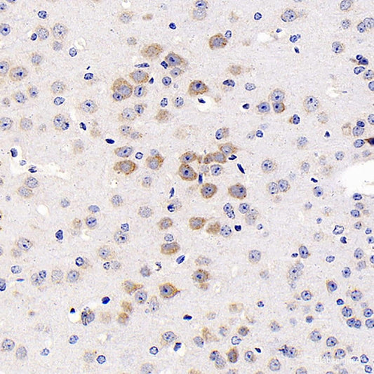 Immunohistochemistry analysis of paraffin-embedded human lymphoma  using S100A4 Monoclonal Antibody at dilution of 1:300.