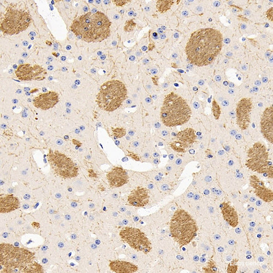 Immunohistochemistry analysis of paraffin-embedded Human lung cancer  using P38 Polyclonal Antibody at dilution of 1:500.