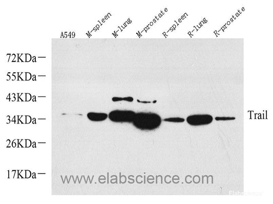 Immunohistochemistry of paraffin-embedded Human lung cancer using c-Fos Polyclonal Antibody at dilution of  1:150 (40x lens).