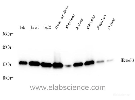 Immunohistochemistry of paraffin-embedded Human breast cancer using NEFL Polyclonal Antibody at dilution of  1:200 (40x lens).