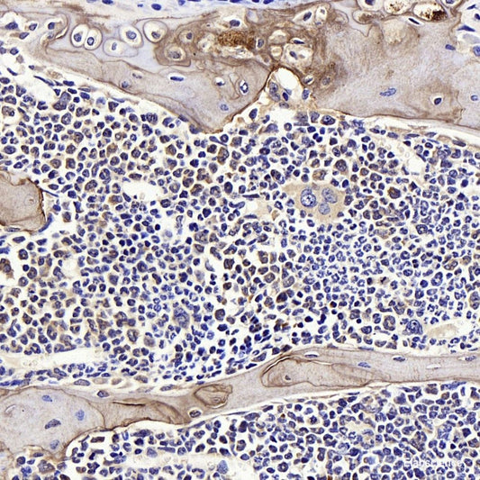 Immunohistochemistry of paraffin-embedded Human liver cancer using Cyclin D1 Polyclonal Antibody at dilution of  1:100 (40x lens).