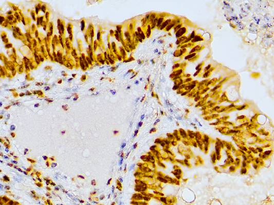 Mismatch Repair Protein 2, MSH2