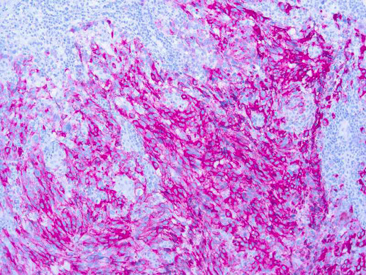 Melanoma